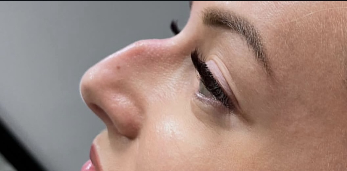 Dorsal hump before treatment